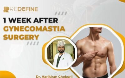 1 Week After Gynecomastia Surgery: What to Expect