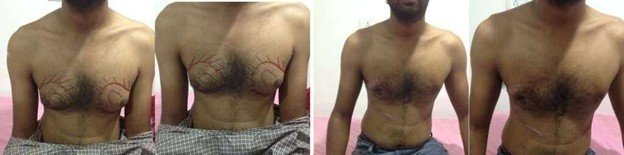 Gynecomastia Before/After