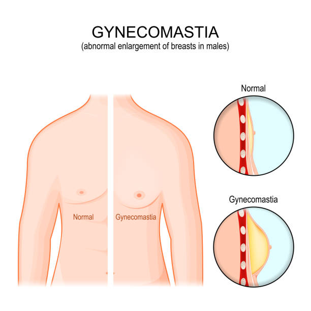 Gynecomastia