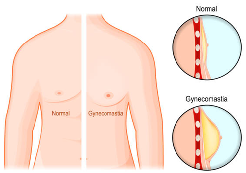 Gynecomastia