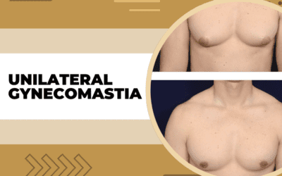 Unilateral Gynecomastia- A Complete Guide