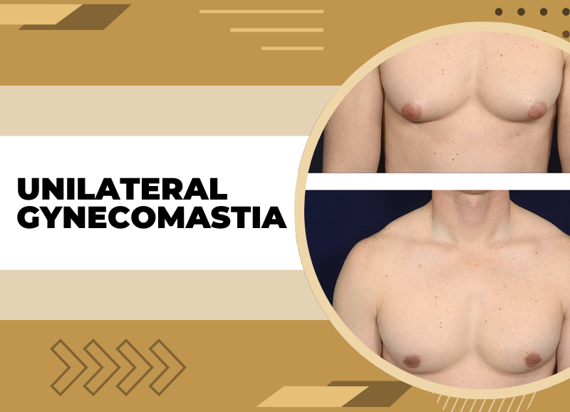 unilateral gynecomastia