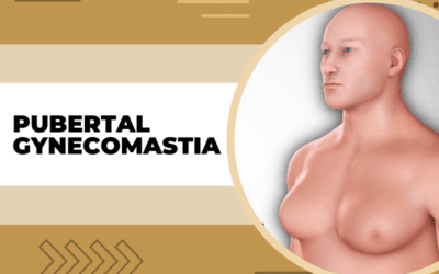 Pubertal Gynecomastia – All You Need To Know