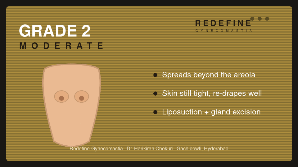 Gynecomastia Grade 2 (moderate) — Redefine, Hyderabad
