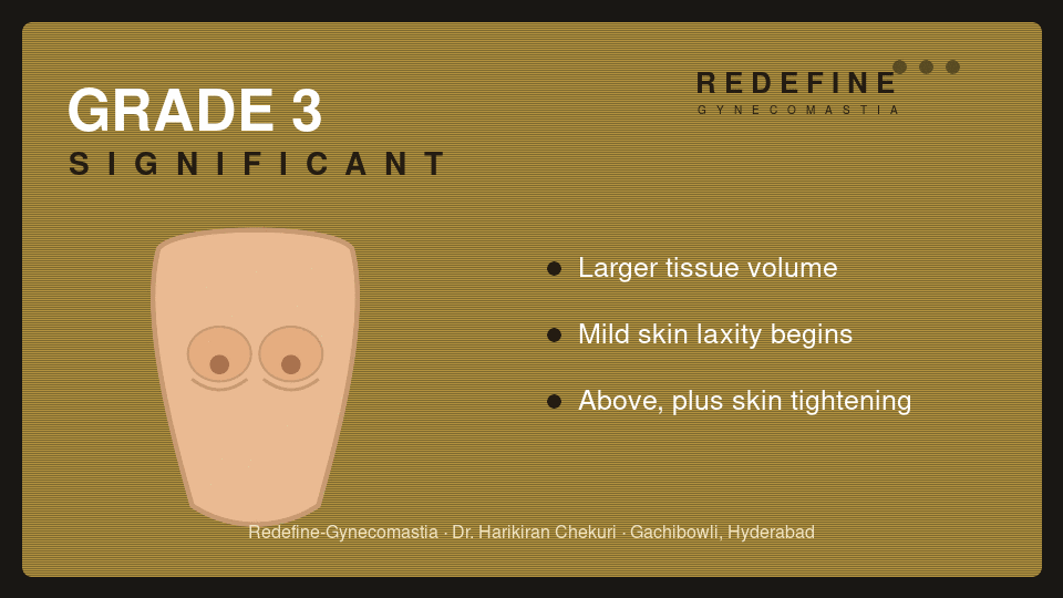 Gynecomastia Grade 3 (significant) — Redefine, Hyderabad