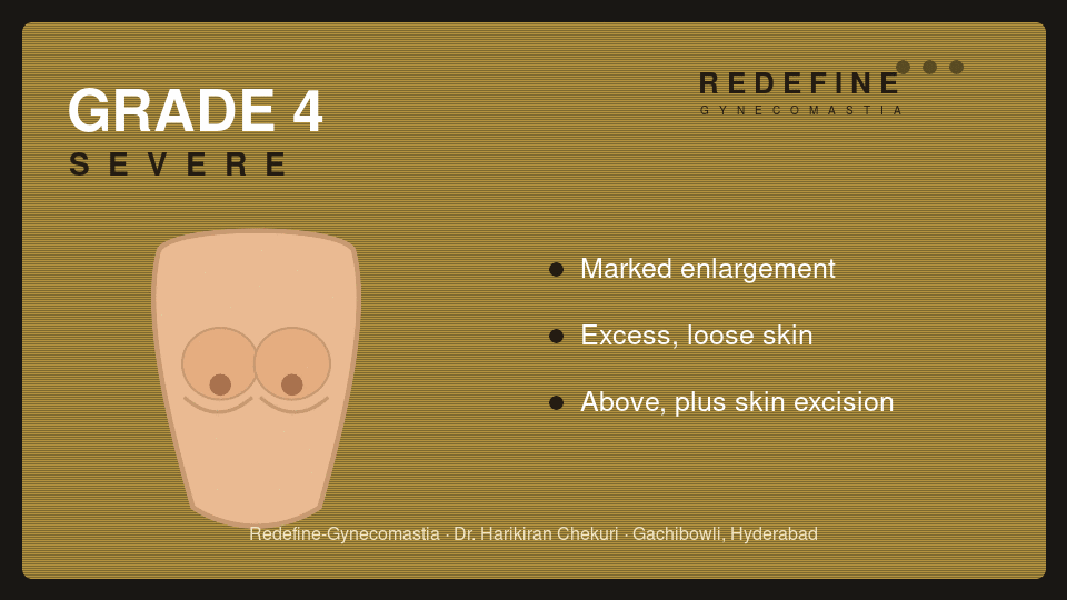 Gynecomastia Grade 4 (severe) — Redefine, Hyderabad